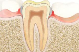 symptomen van tandvleesontsteking